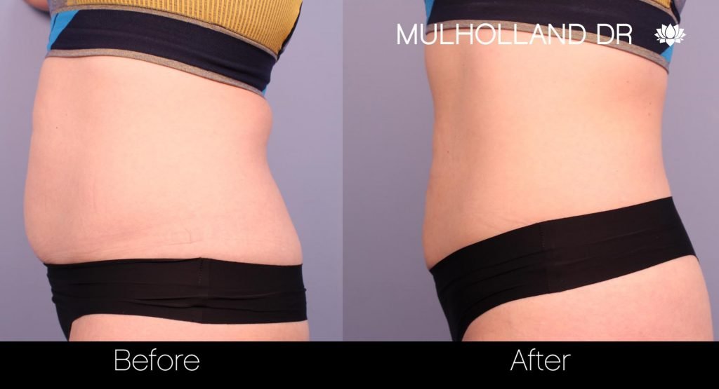 before and after sculpsure photos
