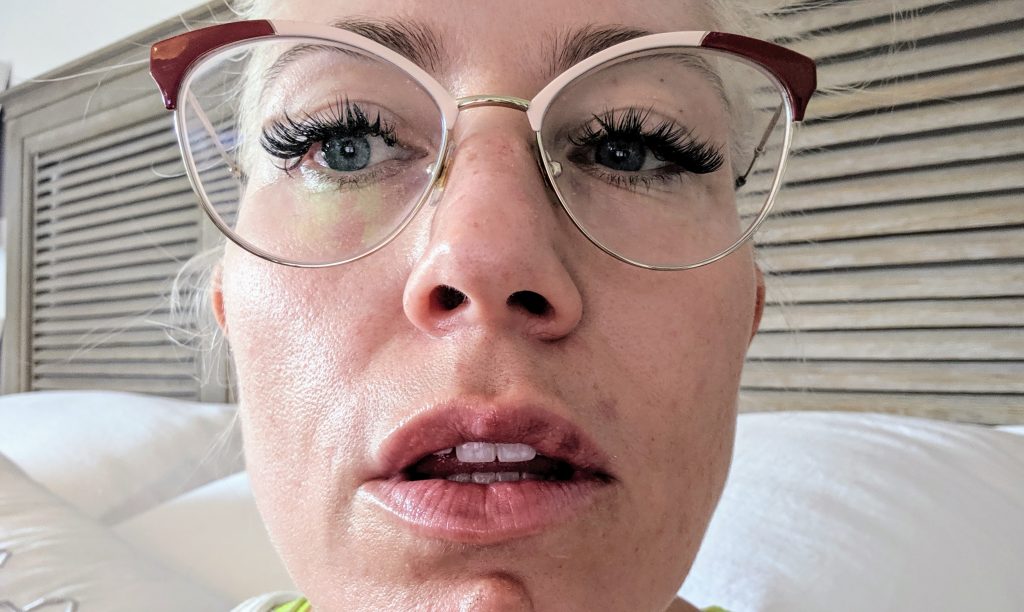 lip filler swelling